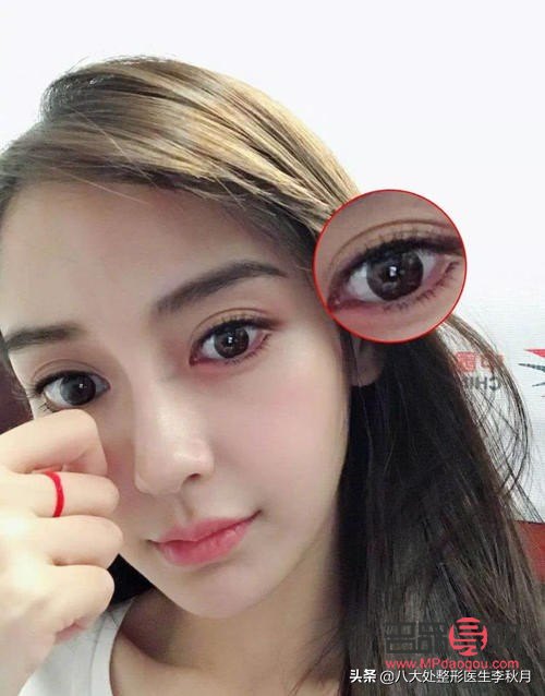 <h3>雙眼皮增生圖片解析與應(yīng)對方法</h3>