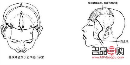 頭懸可以美容嗎(頭部懸厘)