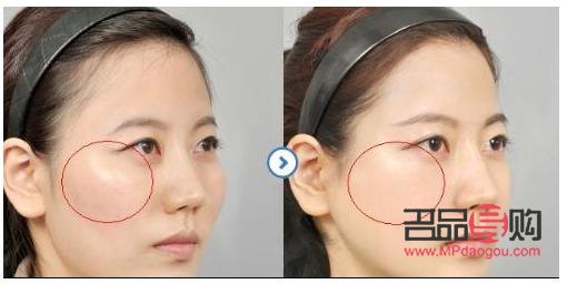 顴骨外擴(kuò)也美容嗎(顴骨外擴(kuò)一定很丑嗎)