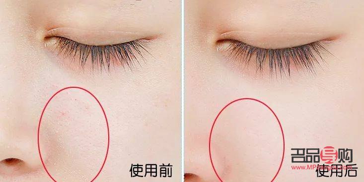 <h3>眼睛下面皺紋怎么去除最有效果</h3>