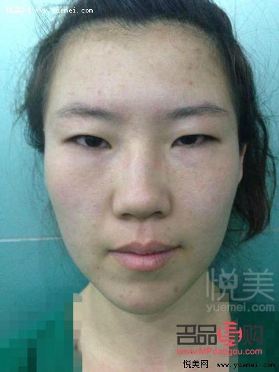 單眼皮眼皮下垂怎么辦(單眼皮眼皮下垂了怎么讓它提上去)