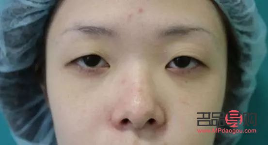 單眼皮眼皮下垂怎么辦(單眼皮眼皮下垂了怎么讓它提上去)