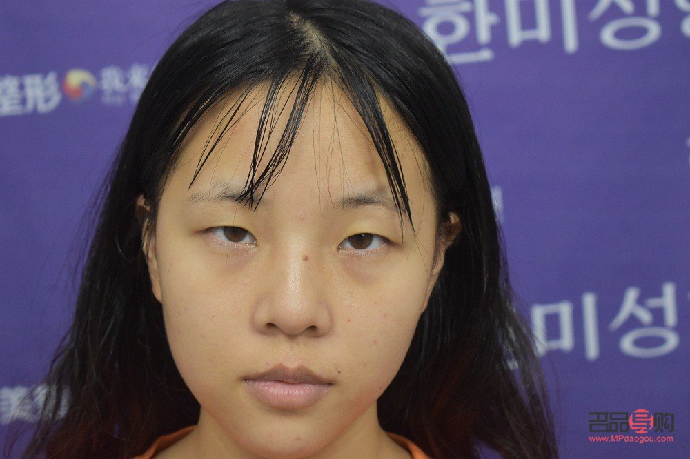 單眼皮眼皮下垂怎么辦(單眼皮眼皮下垂了怎么讓它提上去)