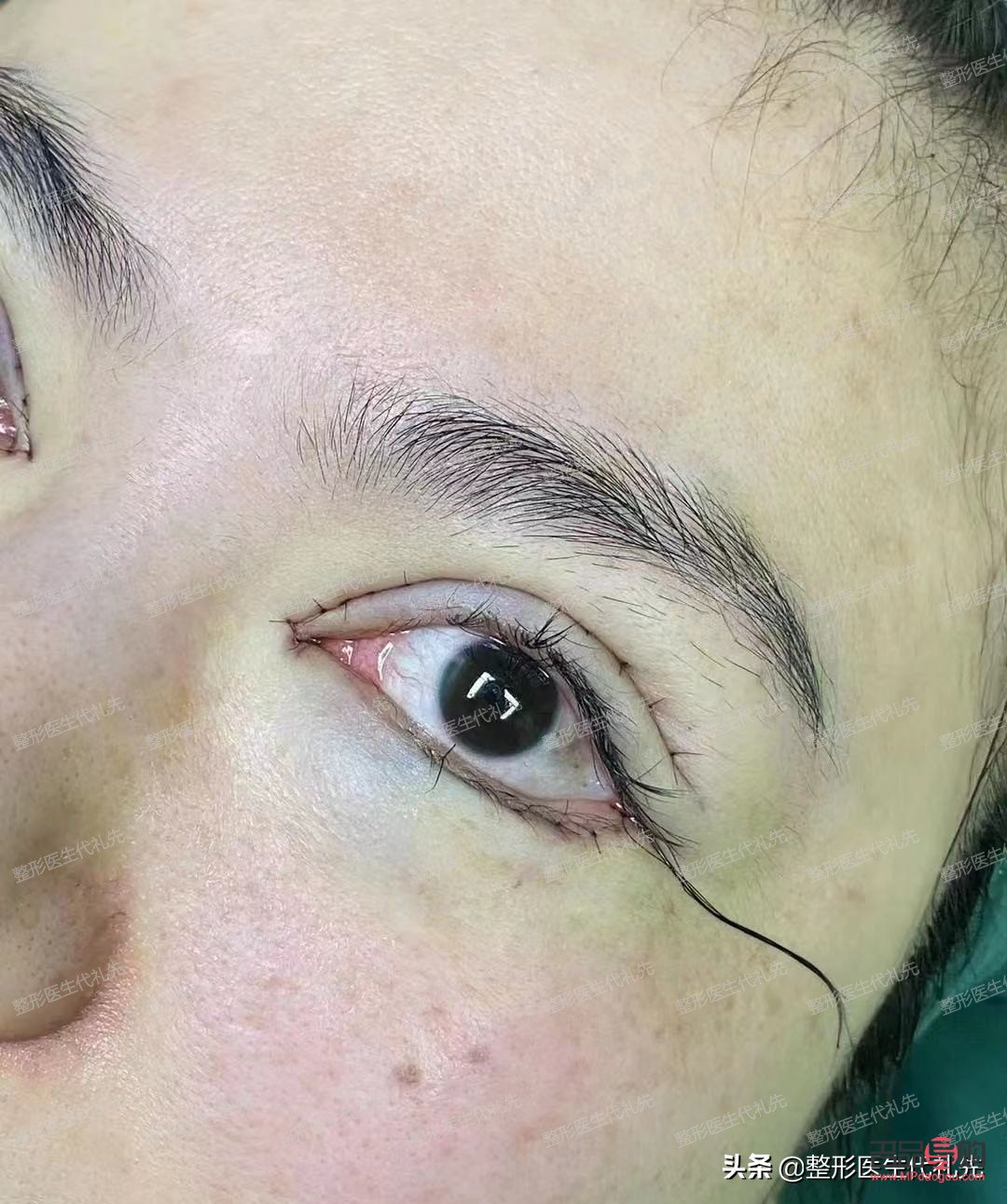 割雙眼皮是全切好還是埋線好(割雙眼皮是全切好還是埋線好一點)