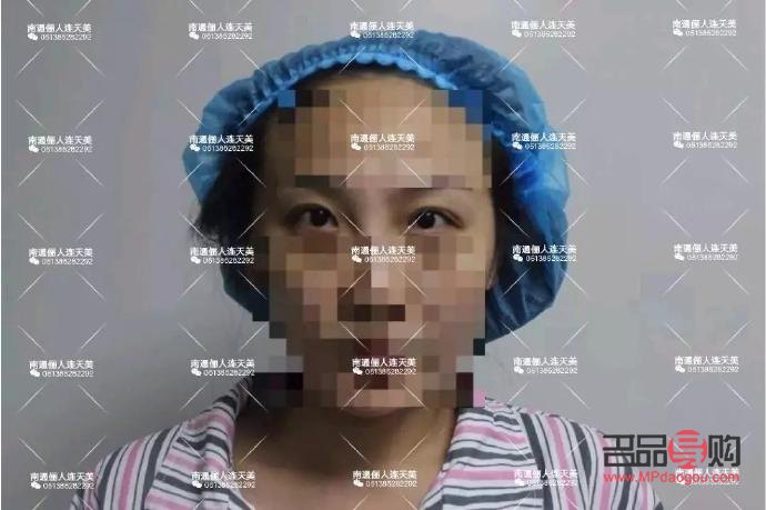 割雙眼皮是全切好還是埋線好(割雙眼皮是全切好還是埋線好一點)