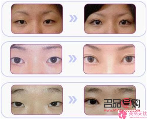 如何讓內(nèi)雙眼皮變外雙眼皮呢