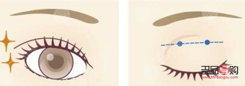 <h3>全切雙眼皮手術(shù)：塑造明亮雙眼的優(yōu)選方案</h3>