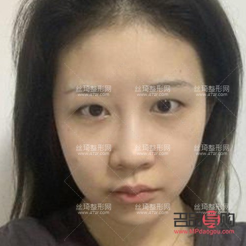 全切雙眼皮手術(shù)：塑造明亮雙眼的優(yōu)選方案