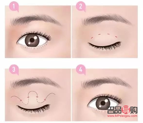 <h3>一單一雙可以做雙眼皮手術(shù)嗎？</h3>