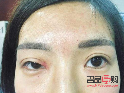 甲狀腺手術(shù)后眼睛一大一小怎么辦(甲狀腺手術(shù)后眼睛一大一小怎么辦呀)