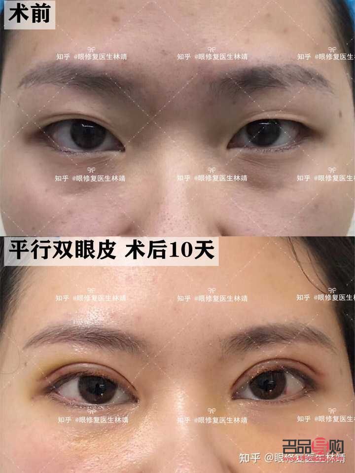 甲狀腺手術(shù)后眼睛一大一小怎么辦(甲狀腺手術(shù)后眼睛一大一小怎么辦呀)