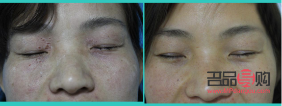 <h3>汗管瘤眼部激光多少錢？全面解析激光治療汗管瘤的費用問題</h3>