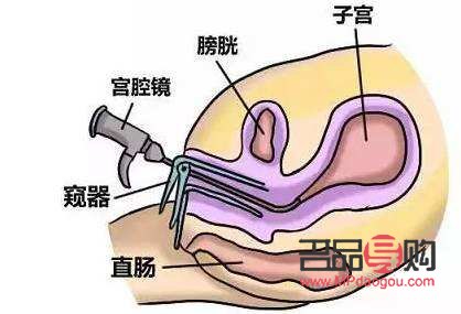 刮宮后如何護(hù)理身體
