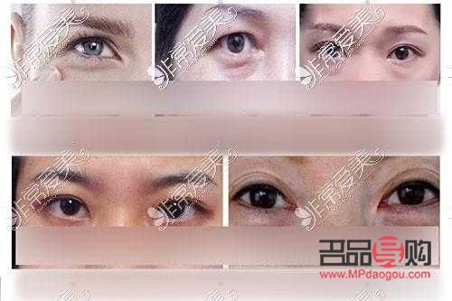 眼角提拉手術的費用大概是多少錢？全面解析手術價格因素