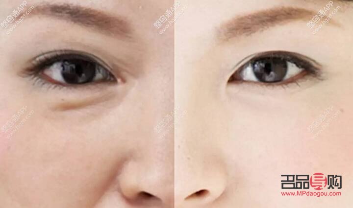 <h3>怎樣淡化淚溝和眼袋</h3>