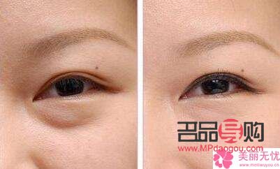 眼袋修復(fù)專(zhuān)家排名(眼袋修復(fù)專(zhuān)家排名)