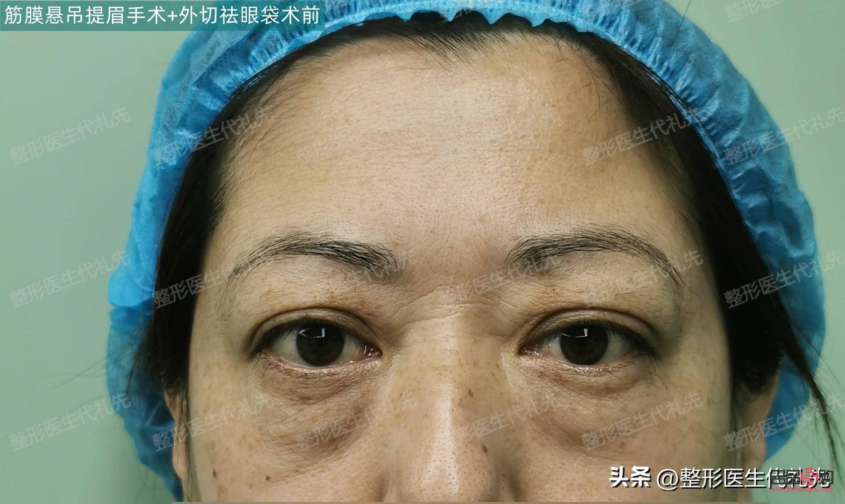 眼袋修復(fù)專家排名(眼袋修復(fù)專家排名)