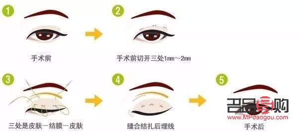 <h3>割雙眼皮1萬(wàn)6是否貴？全面解析雙眼皮手術(shù)價(jià)格與價(jià)值</h3>