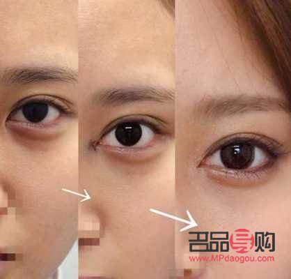 <h3>眼部綜合整形價格是多少？全面解析眼部整形費用及影響因素</h3>