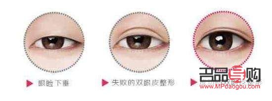 <h3>眼部綜合整形價格是多少？全面解析眼部整形費用及影響因素</h3>