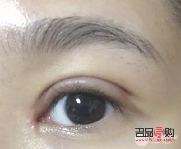 微創(chuàng)雙眼皮10天恢復圖(微創(chuàng)雙眼皮10天恢復圖片大全)