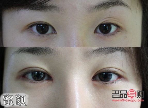 微創(chuàng)雙眼皮10天恢復(fù)圖(微創(chuàng)雙眼皮10天恢復(fù)圖片大全)