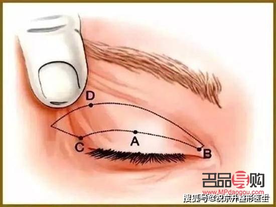 提拉眼皮需要多少錢一次(提拉眼皮需要多少錢一次手術(shù))