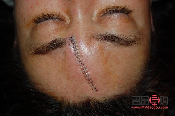 <h3>美容縫線如何拆除</h3>