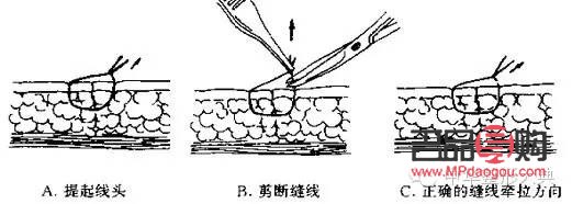 <h3>美容縫線如何拆除</h3>