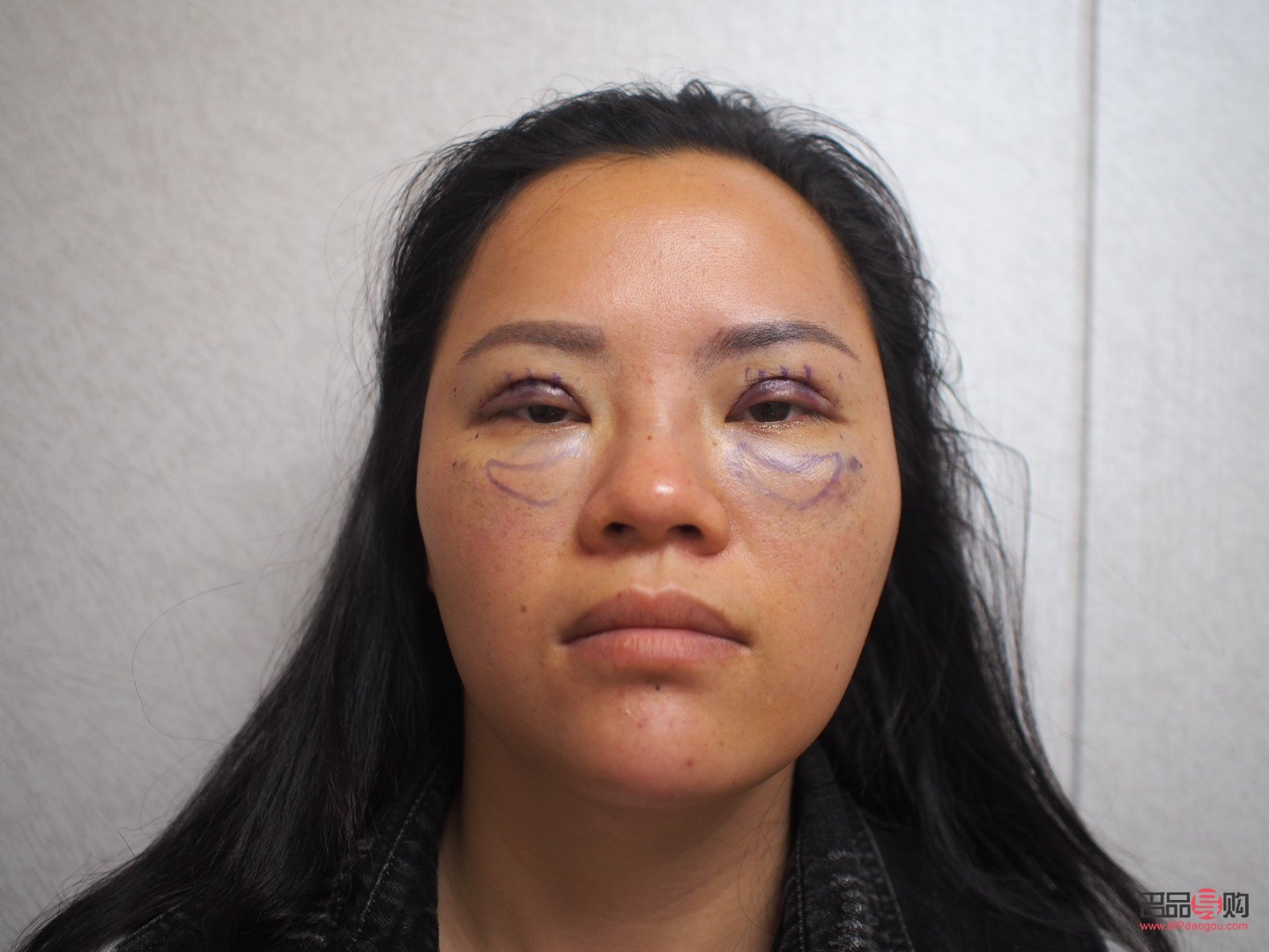 40歲后慎割雙眼皮(40歲后慎割雙眼皮一年自然)