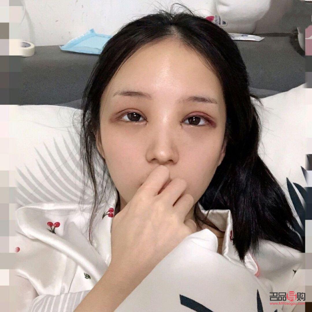 40歲后慎割雙眼皮(40歲后慎割雙眼皮一年自然)