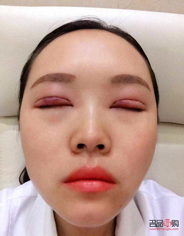 40歲后慎割雙眼皮(40歲后慎割雙眼皮一年自然)