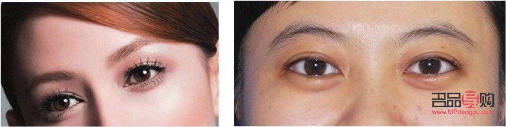 <h3>眼輪匝肌折疊臥蠶再造——上海九院打造迷人電眼新選擇</h3>