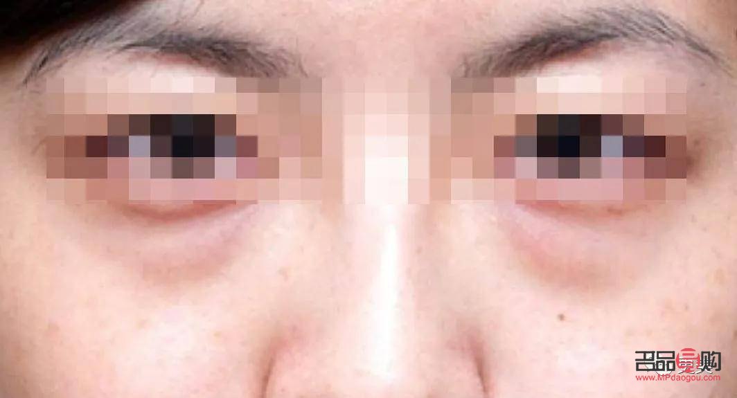 眼下八字淚溝怎么消除(眼下八字淚溝怎么消除圖片)