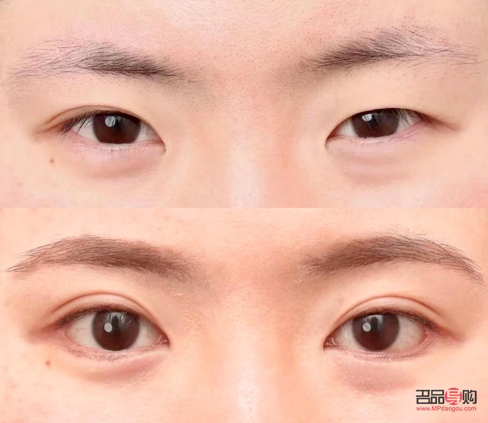 一單一雙眼皮怎么改善不割(一單一雙眼皮怎么矯正除了手術(shù))