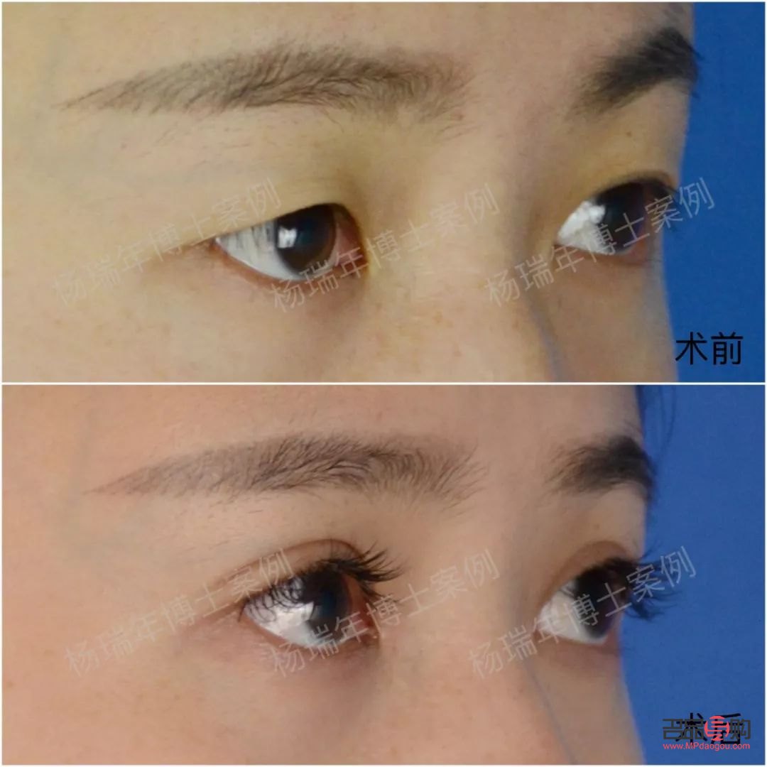 一單一雙眼皮怎么改善不割(一單一雙眼皮怎么矯正除了手術(shù))