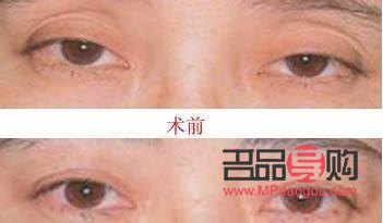 眼皮下垂怎么自然恢復(fù)吃什么好(眼皮下垂怎么做會(huì)改善)