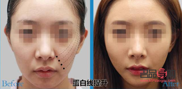 <h3>線雕美容安全嗎</h3>