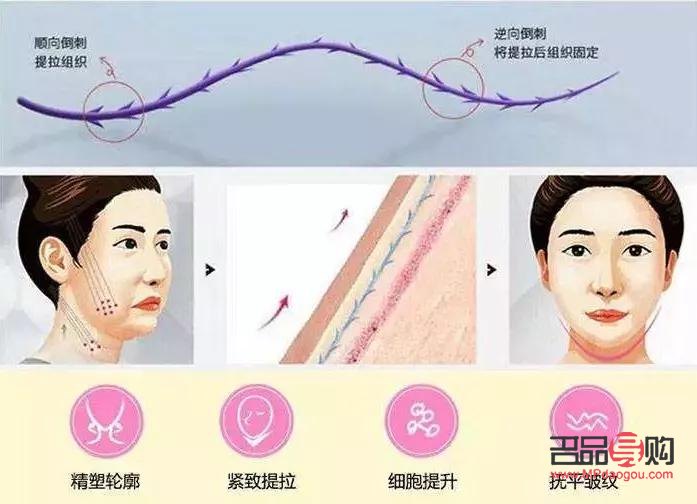 線雕美容安全嗎