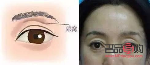 眼窩凹陷脂肪填充能維持多久