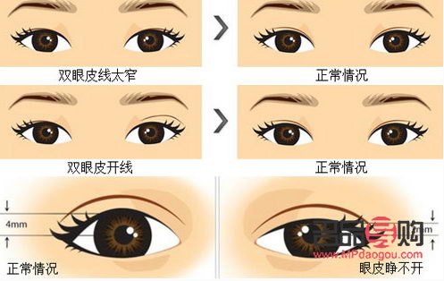 新月形的雙眼皮圖片大全(新月形的雙眼皮圖片大全大圖)