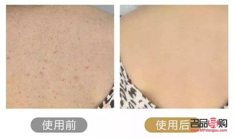 身體去毛后怎么護(hù)理呢(身體去毛后怎么護(hù)理呢圖片)