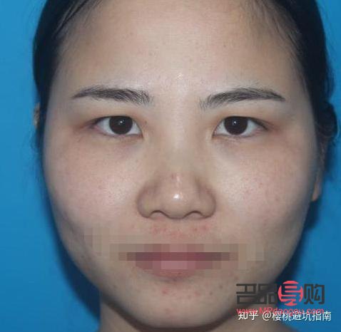 <h3>日式無(wú)痕雙眼皮與全切雙眼皮：哪個(gè)更優(yōu)？</h3>