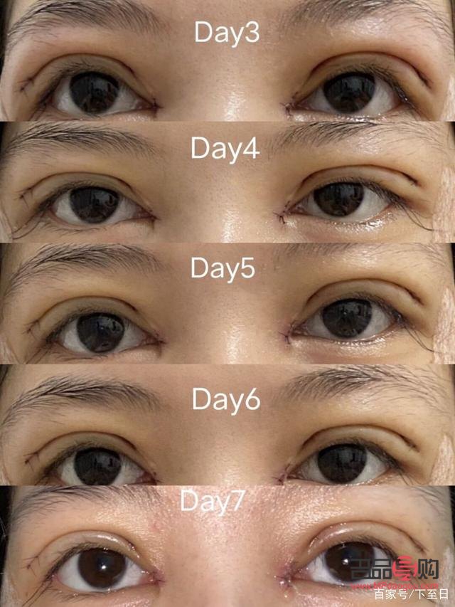 什么雙眼皮恢復(fù)期最快(什么雙眼皮恢復(fù)期最快呢)