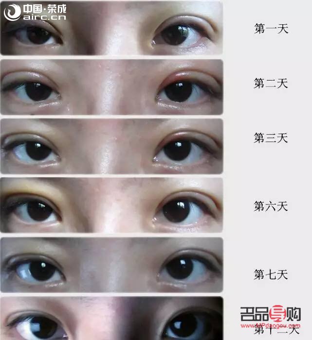 什么雙眼皮恢復(fù)期最快(什么雙眼皮恢復(fù)期最快呢)