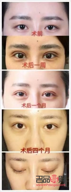 什么雙眼皮恢復(fù)期最快(什么雙眼皮恢復(fù)期最快呢)