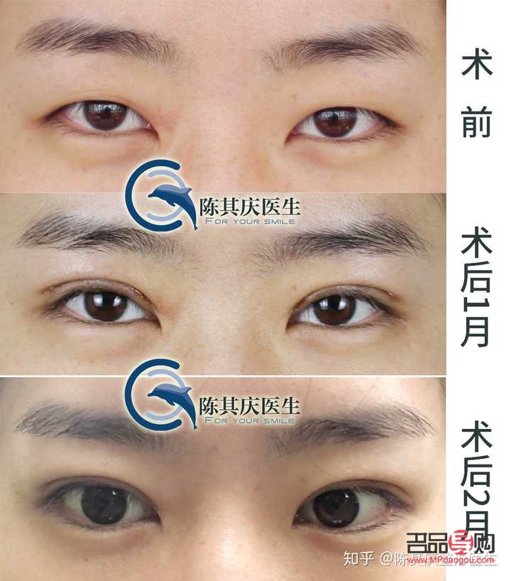 <h3>哪種雙眼皮最好看最安全可靠</h3>