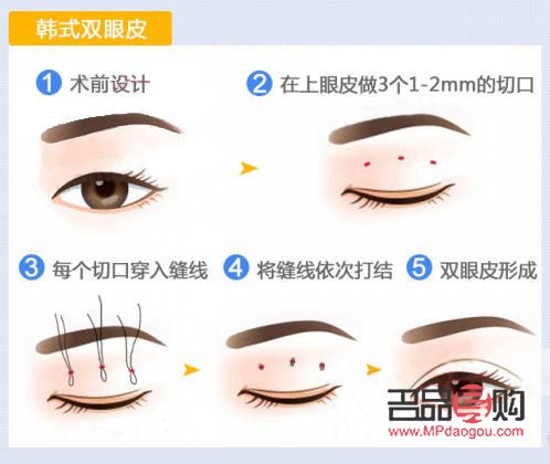 <h3>哪種雙眼皮最好看最安全可靠</h3>