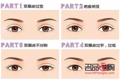 <h3>哪種雙眼皮最好看最安全可靠</h3>