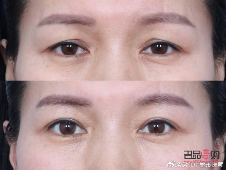 眼皮松弛了還能恢復(fù)嗎圖片(眼皮松弛了還能恢復(fù)嗎圖片大全)